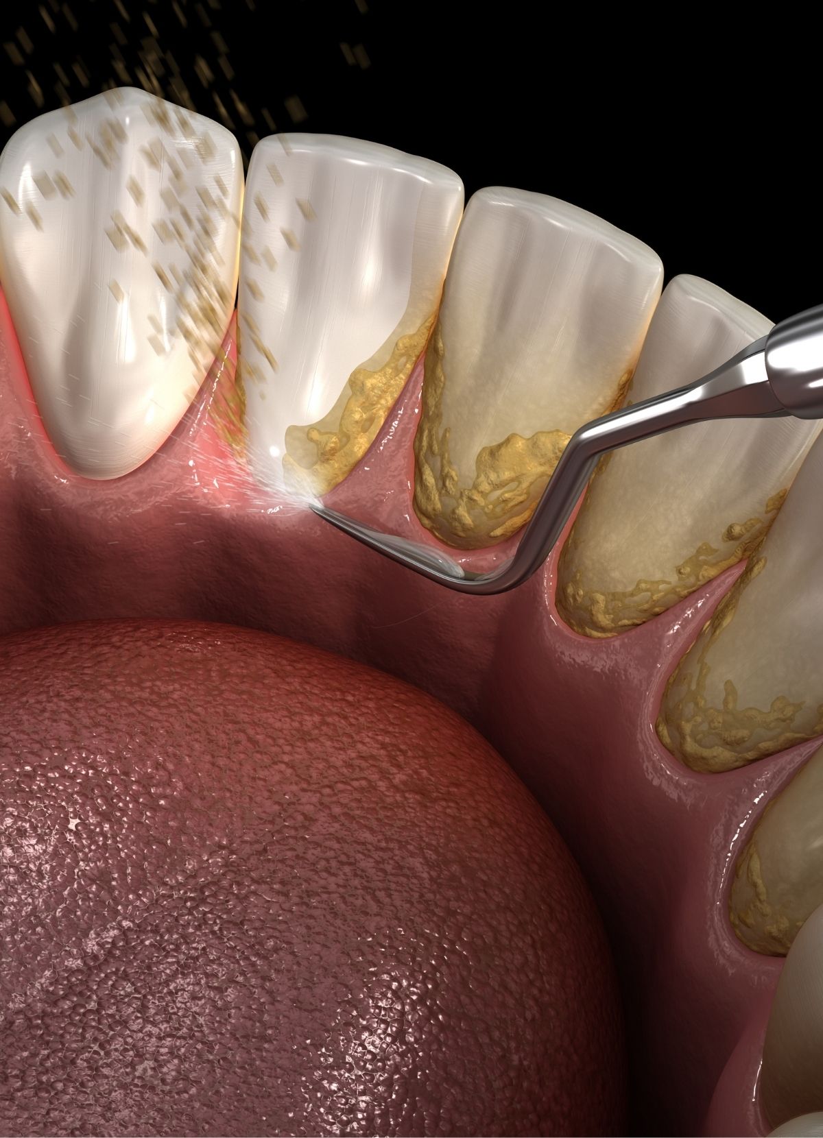 https://mahmutlardentist.com/wp-content/uploads/2024/11/mahmutlar-dis-klinigi-dis-tasi-temizligi-3.jpg