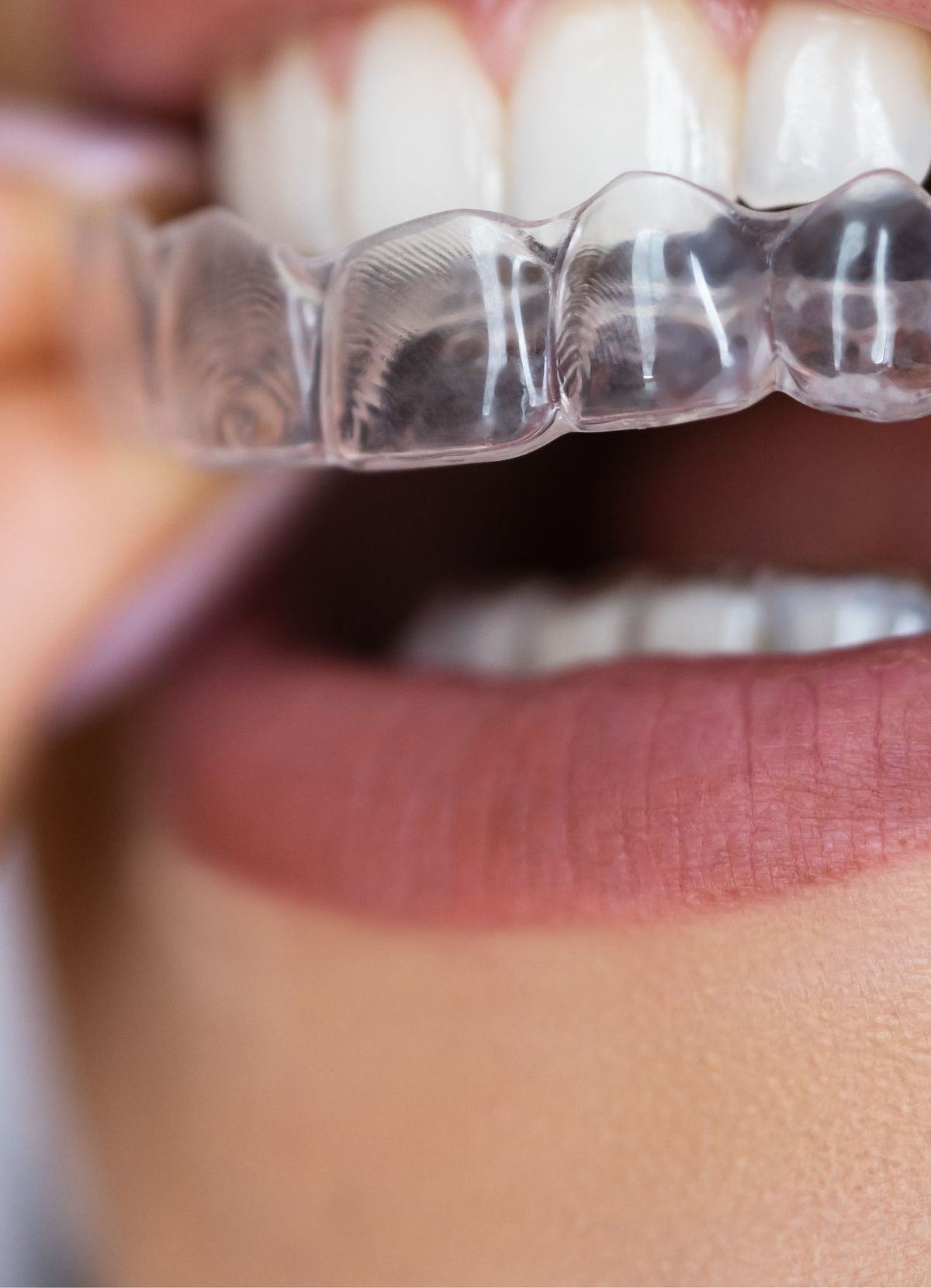 https://mahmutlardentist.com/wp-content/uploads/2024/12/mahmutlar-dis-klinigi-seffaf-plak-Invisalign-tedavisi.jpg